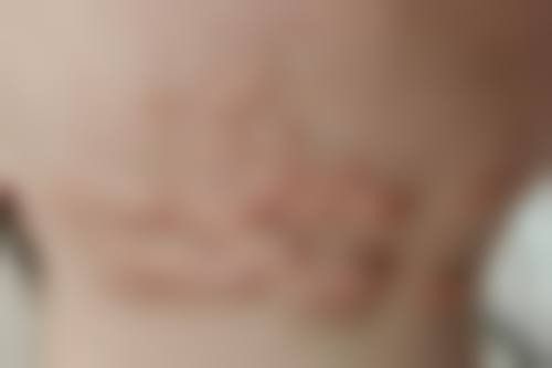 面部疤痕修复术多少钱？价格明细来啦！