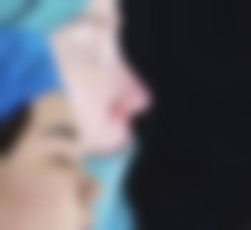 肋骨隆鼻价格参考：一分钱一分货别贪便宜