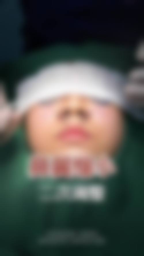 线提升隆鼻与假体隆鼻，技术优势对比