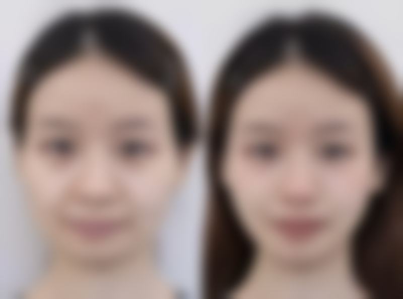 真人实例分享:见证上臂吸脂消肿奇迹