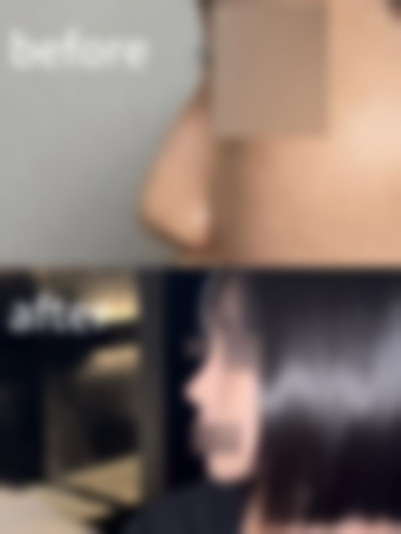 揭秘上臂吸脂术后快速消肿方法