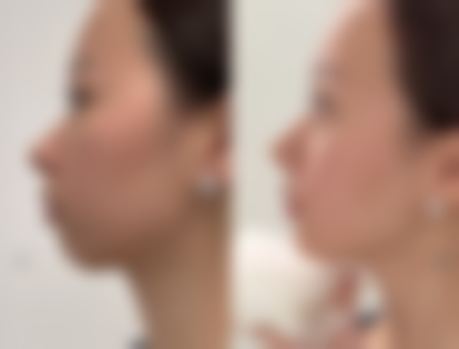 {超声波去眼袋有风险吗？风险极低！原理科学、过程安全且术后恢复快，放心选！费用 3000 - 10000 元不等，速来了解 