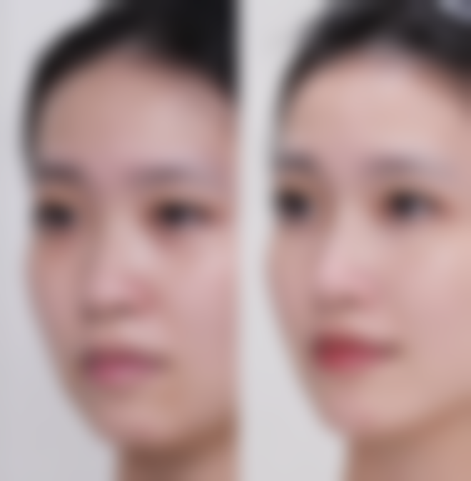 肋骨隆鼻后遗症吗？当然有！如感染、变形等，术后护理不当还会加重风险！医生教你3招避免鼻梁歪斜和吸收问题