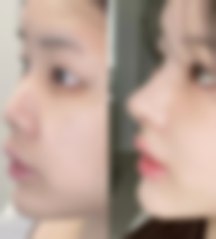 线提升隆鼻与假体隆鼻，优缺点大揭秘