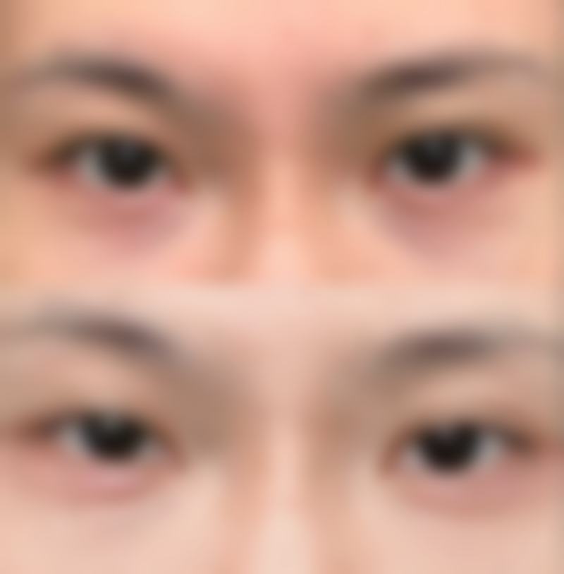 超声波去眼袋术后护理攻略，让成效更持久