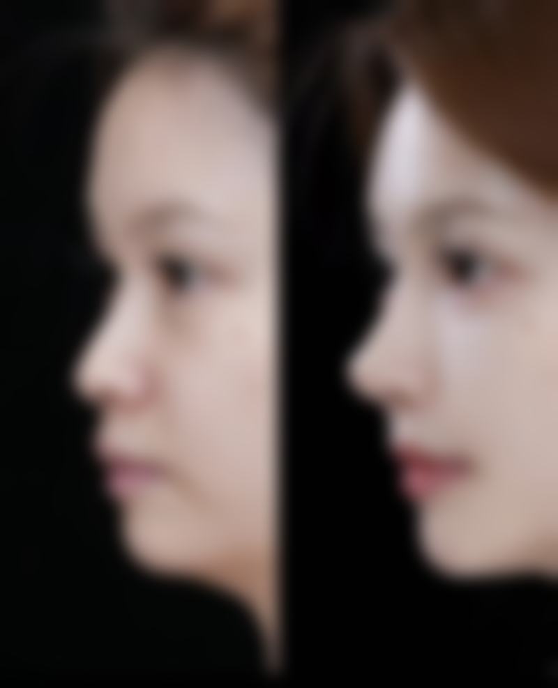 线提升隆鼻与假体隆鼻，成效与口碑如何？