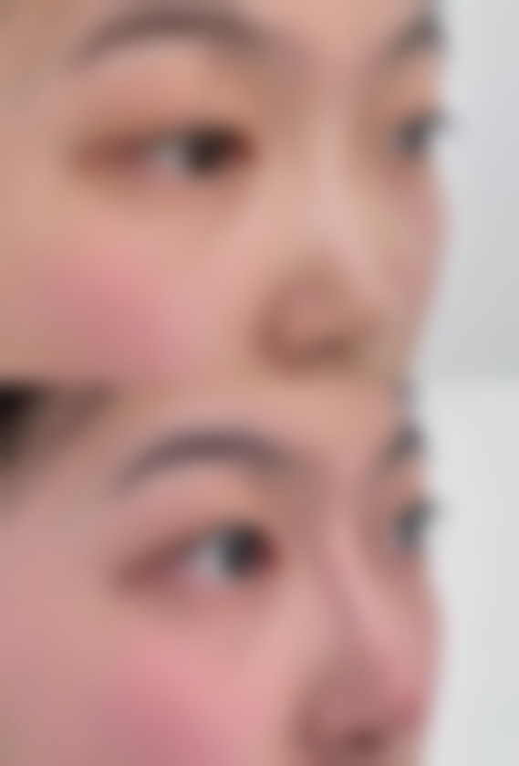 科学护理避坑指南：肋骨隆鼻后注意事项及护理全解析