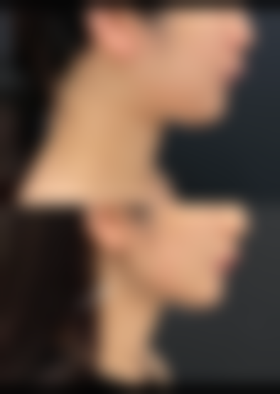 划重点！全切双眼皮与抽烟的时间关系