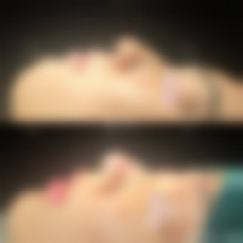 十一、在决定经期隆鼻前,普通用户更容易忽略的关键信息