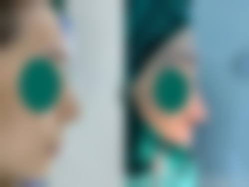 五、在实际操作中,经期隆鼻更适合哪些人?