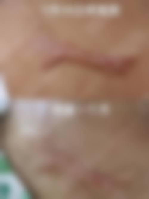 脸部摔伤疤痕修复常见并发症或后遗问题,在临床中如何理解其发生概率?