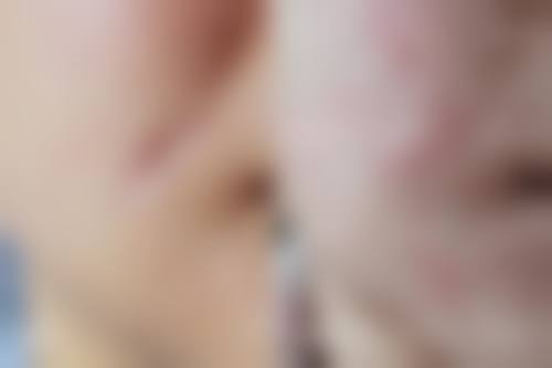 小切口筋膜悬吊术能维持几年?