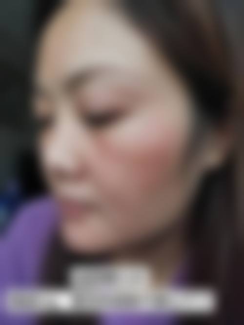 不同医生资质对激光祛斑价格的影响