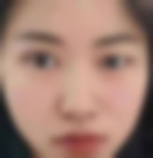 吹风对双眼皮手术成效的长期影响