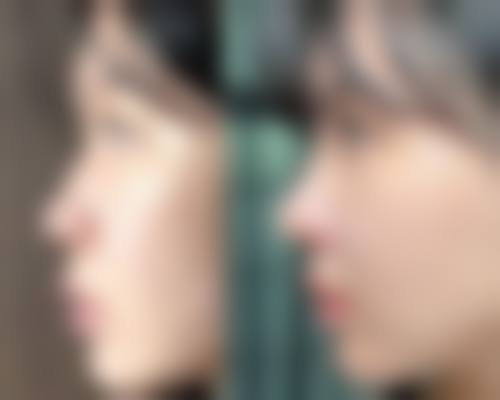 深圳艺星热门项目价格表：双眼皮/吸脂/热玛吉多少钱？性价比极高！