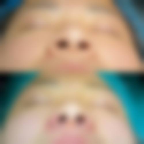 搞懂“隆鼻术后多久拆线更好”,这些避坑要点别踩