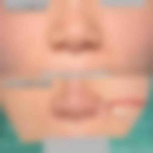 八、经期隆鼻的成效稳定性取决于哪些因素?