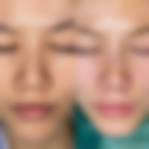 九、围绕经期隆鼻,临床中更常见的并发问题有哪些?