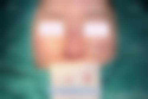 二、经期隆鼻通常在什么阶段被纳入医疗选择范围?