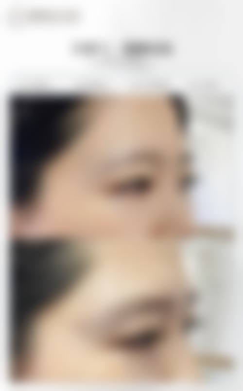 {做完双眼皮能出门吹风吗？专家揭秘：伤口无感染、做好防护完全可行！ 