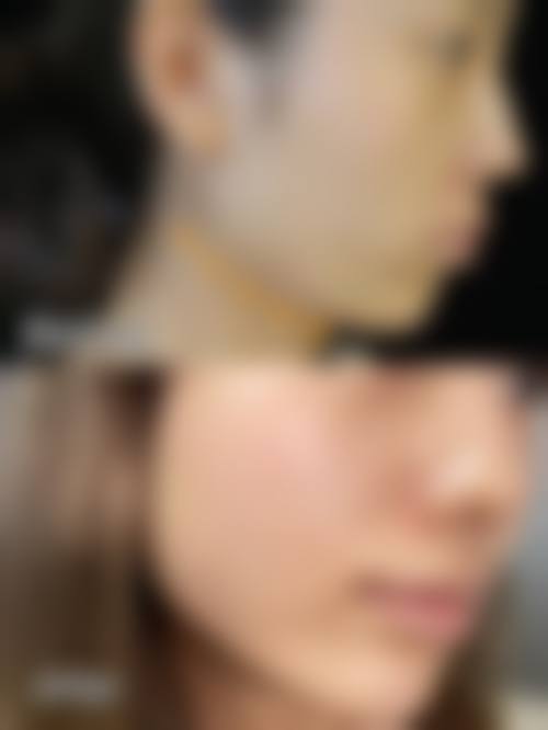 溶脂针和吸脂针哪个更安心?医院和医生的选择特别关键!