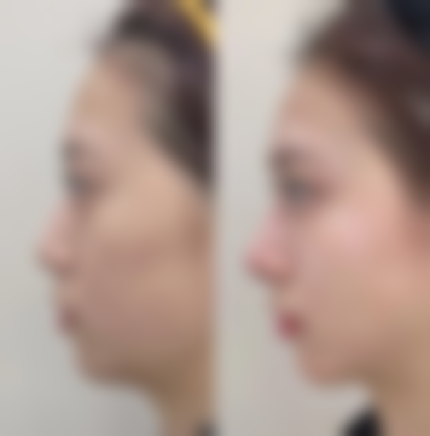 不同隆鼻手术方式对应的“隆鼻之后多久拆线”明细,附真人实例