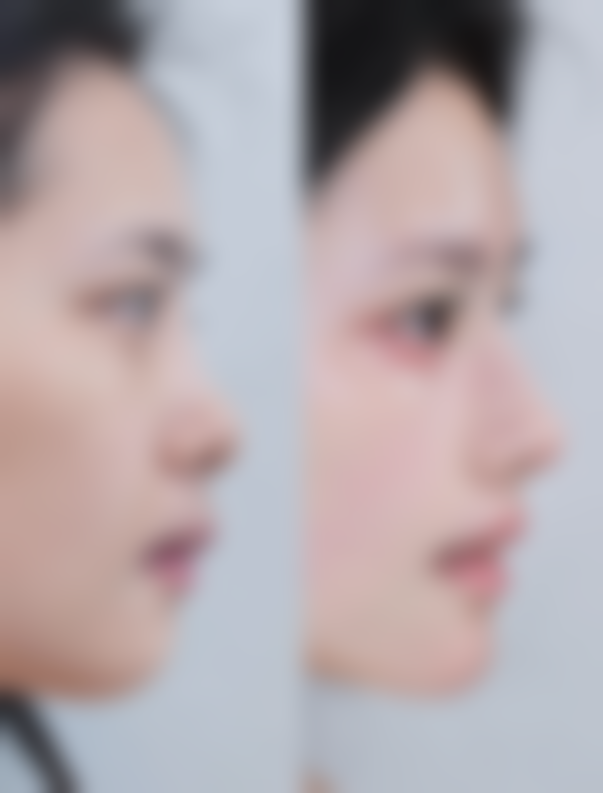 深圳艺星吕瑛医生双眼皮做的好吗？真人实例+技术优势全解析！