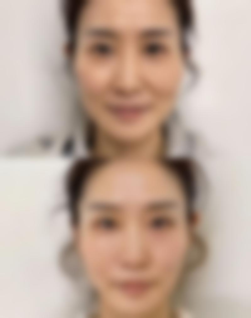 阴道紧缩术术后多久可以同房?遵循修复时间,确保成效与健康