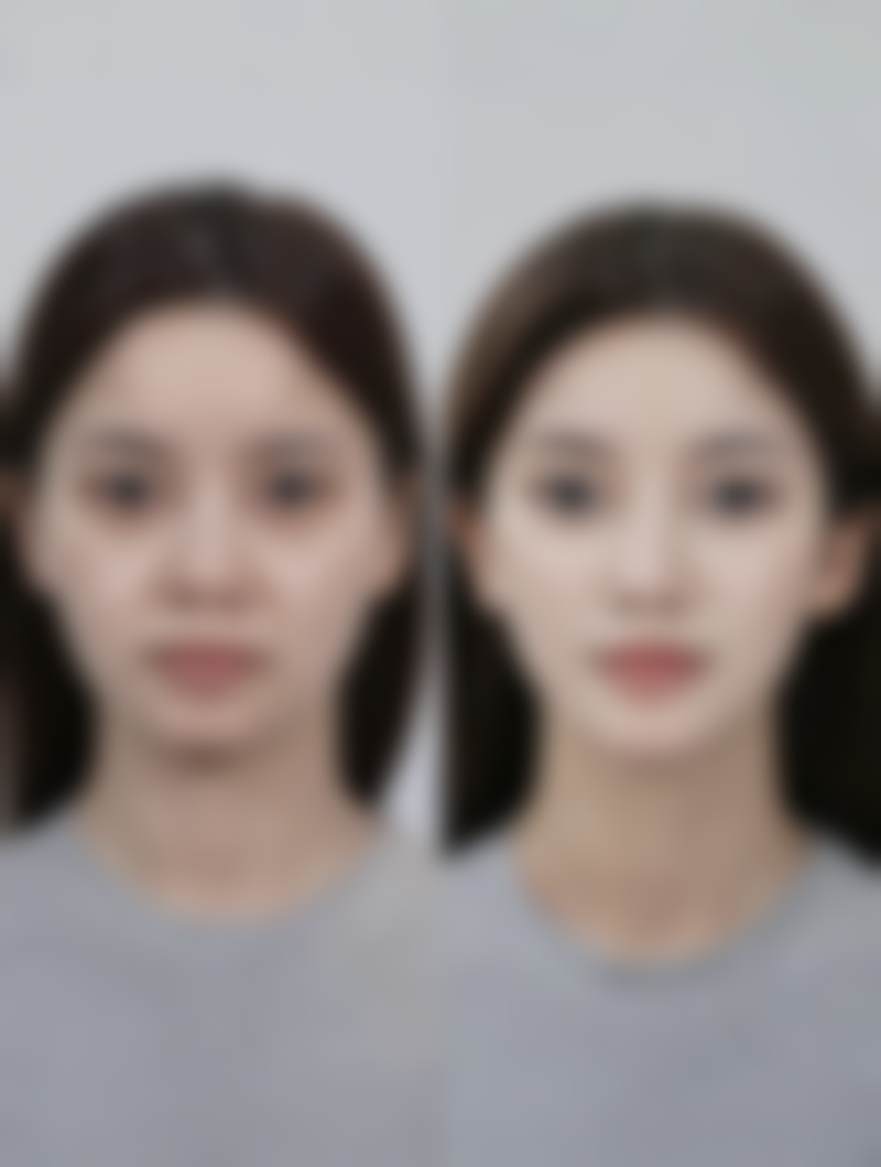 适合玻尿酸注射丰太阳穴的人群