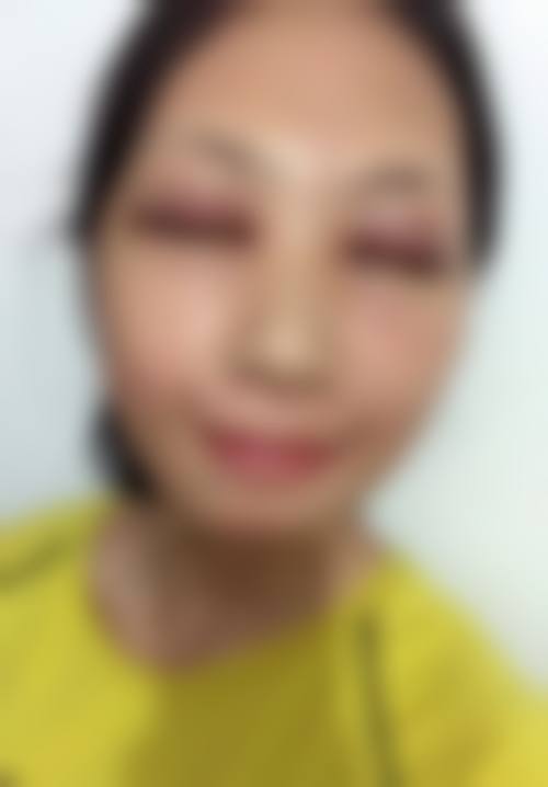 深圳阴道紧缩术