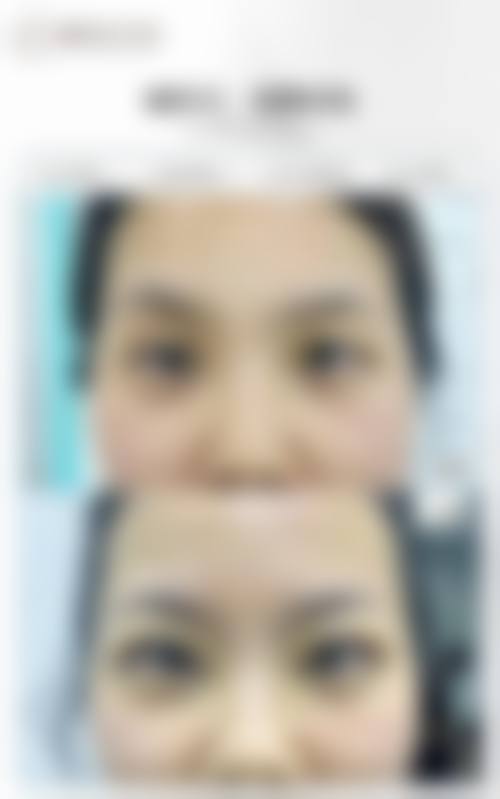 大连爱德丽格谁技术最好？刘志刚王香平眼修复王牌，案例多恢复快口碑爆棚