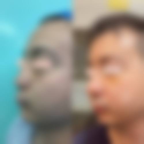 耳软骨隆鼻还能取出来吗？当然能！术后3-6个月无炎症可取出，能复原费用约2-5万