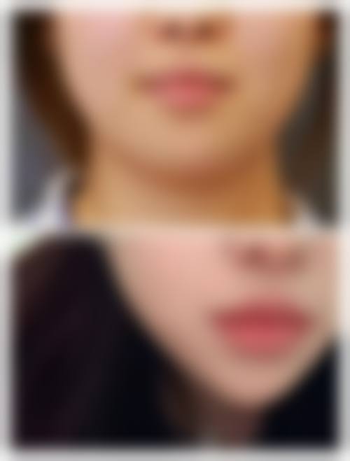 医生价格对深圳乔雅登玻尿酸填充的影响