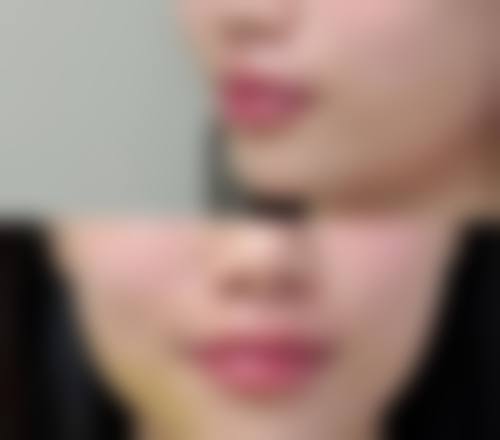 深圳乔雅登玻尿酸填充价格的影响因素及如何选择