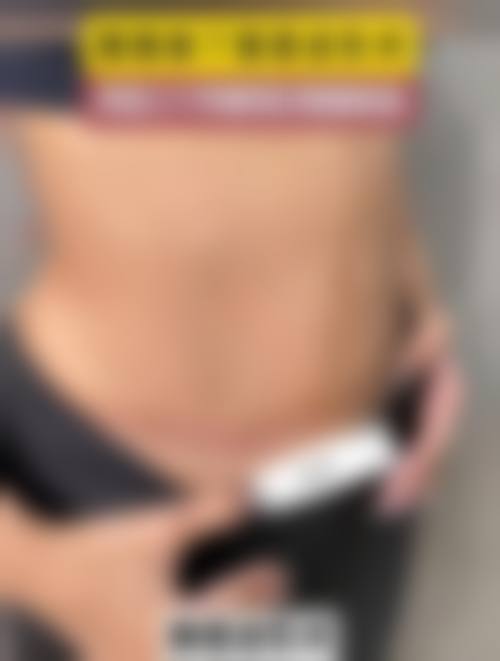 2. 西安叶子整形医院——腹直肌矫正骨干医生,宝妈信赖之选