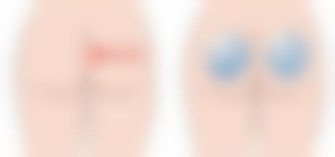 臀部吸脂的价格区间及费用差异来源