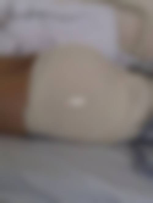 臀部吸脂本身能解决什么、不能解决什么?