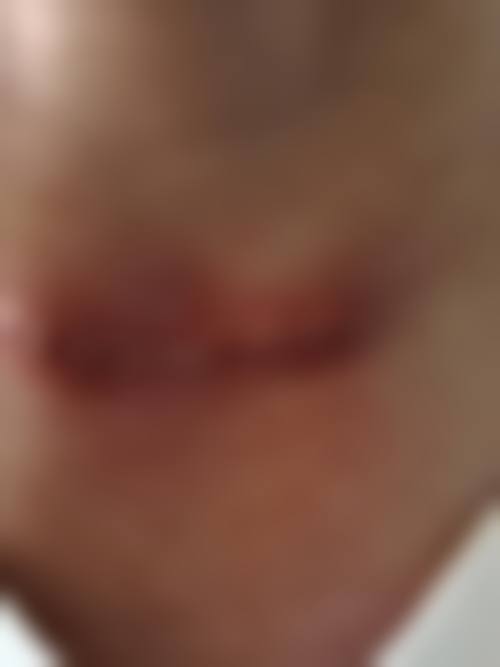 药物祛疤的特点与成效