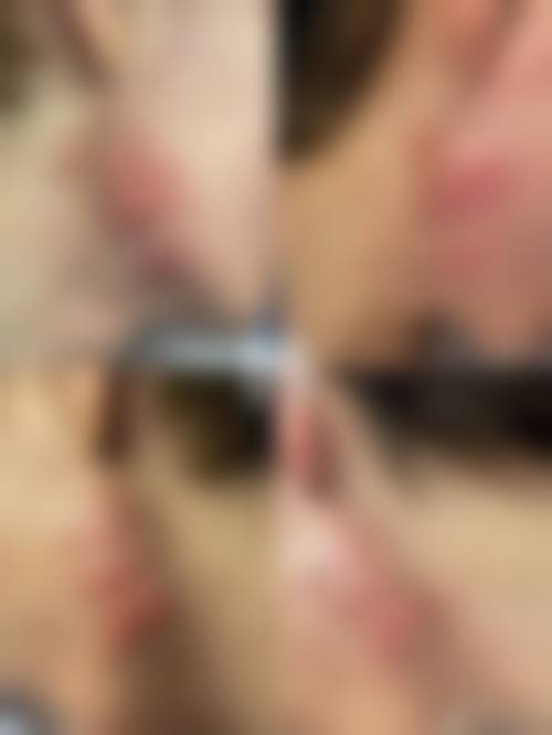 疤痕发红激光有成效吗？真实实例告诉你答案