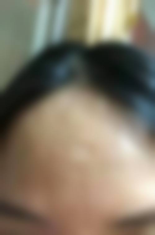 激光祛疤前的必要检查项目