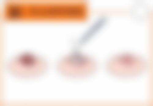 3. 西安高一生美容医院——疤痕处理大师,还原少女腰腹