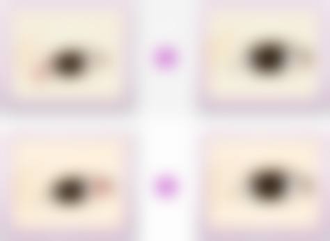 双眼皮宽改窄修复需要多少钱?价格与成效成正比