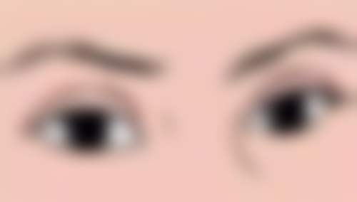 割完双眼皮怎么做眼部运动？哪些反应属于个体差异，哪些情况需要及时复诊