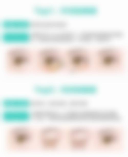 割双眼皮成效能维持多久呢？方法决定时长！