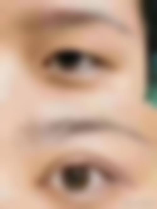 去除眼袋的更有效的方法，综合方案更给力