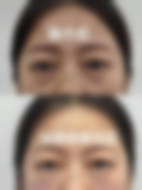 割双眼皮是什么?通常在什么医学背景下被选择?