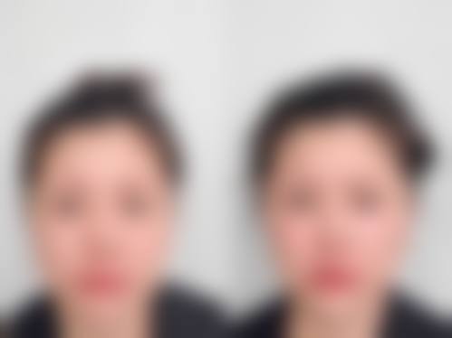 成都恒博天姿整形医院口碑实例：真实见证，美丽蜕变