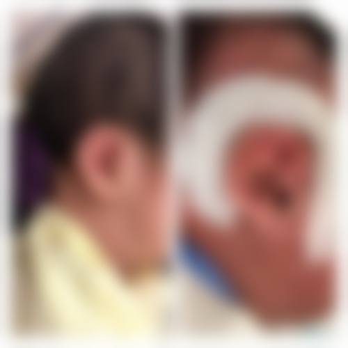 耳朵疤痕疙瘩切除后,只有放疗一种办法预防复发吗?还有其他方法吗?