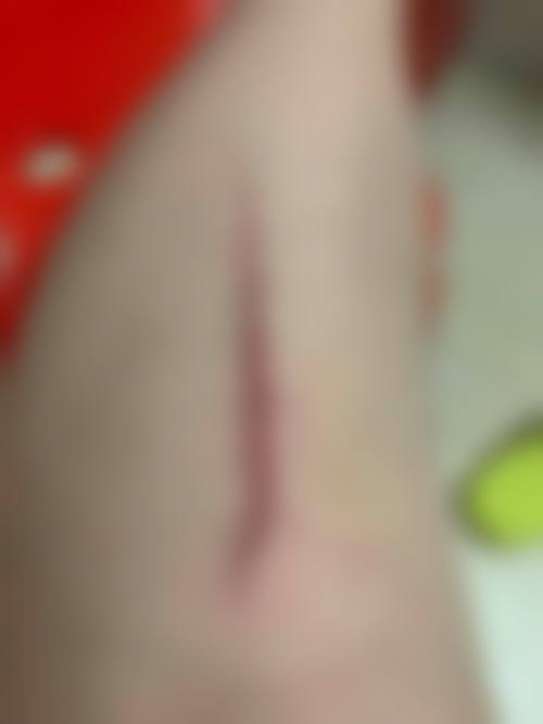 耳朵瘢痕疙瘩手术后放疗的危害大吗?如何应对?