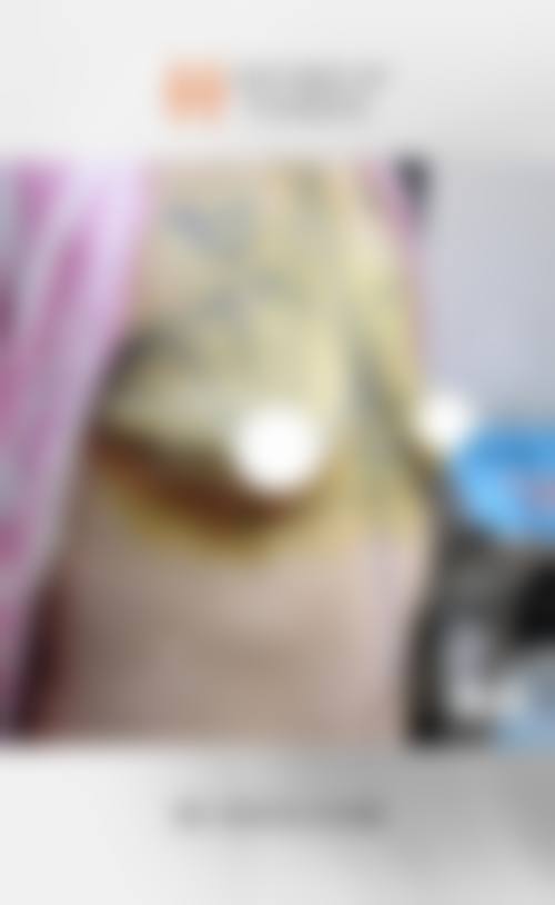 自体脂肪隆胸危害的长期影响有哪些?